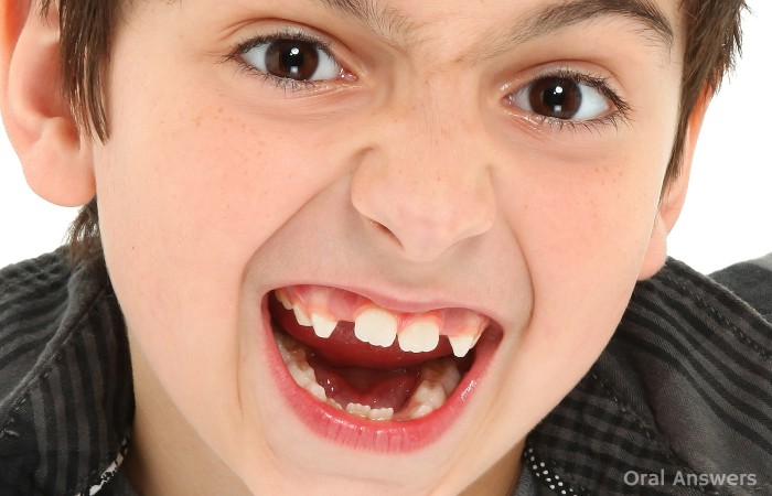 How Spacers Space Maintainers Look In Your Child's Mouth