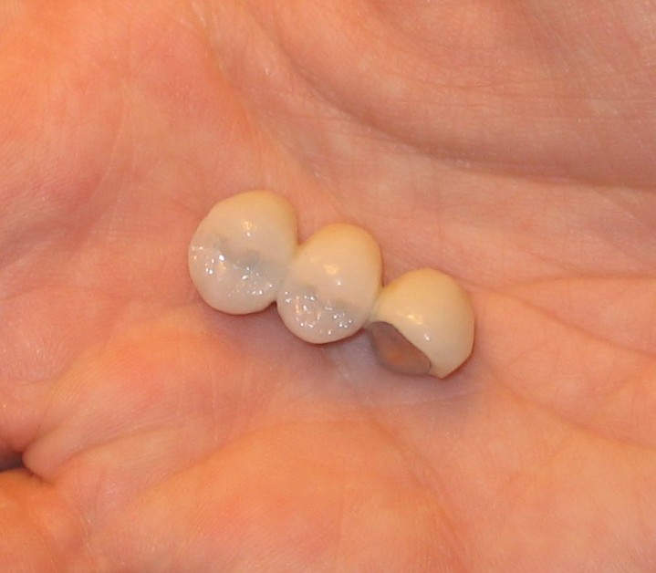 When a Crown or Bridge Falls Out, Go Visit Your Dentist Oral Answers