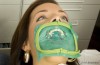 Rubber Dental Dam Advantages