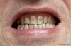 Tetracycline Teeth Staining Cause and Treatments