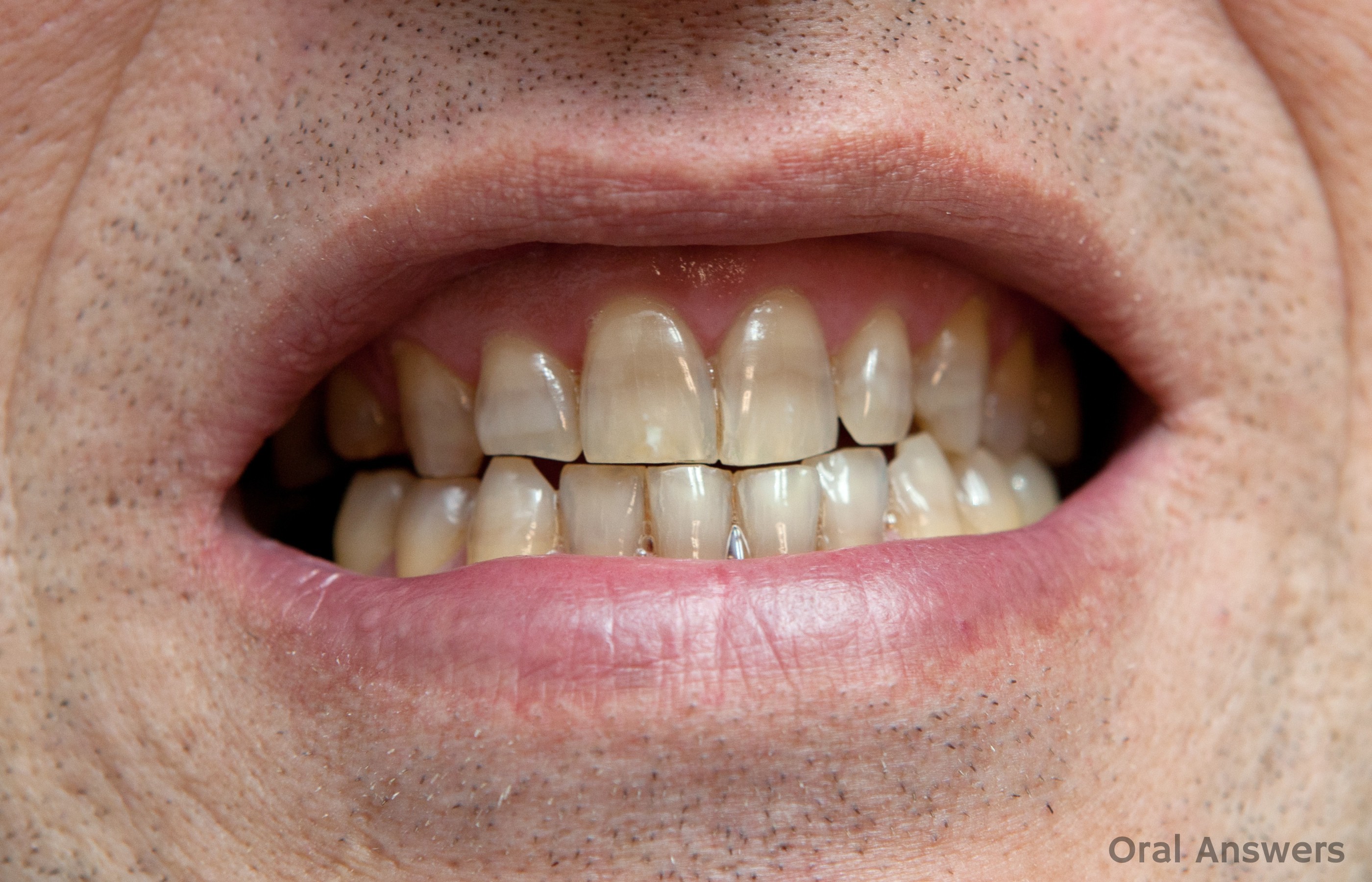 tetracycline teeth staining in adults