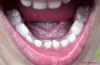 Adult Teeth Coming in Behind Baby Teeth