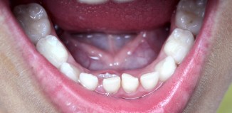 Adult Teeth Coming in Behind Baby Teeth
