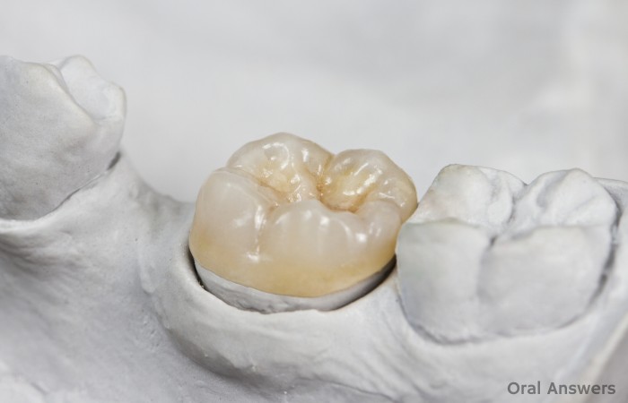 Cavity Under a Dental Crown