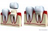 Dental Crown Procedure: What Is a Dental Crown?
