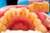 Dental Tartar and Calculus