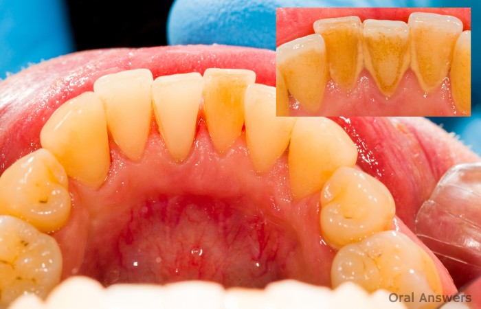 What are Tartar and Calculus? | Oral Answers