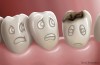 Tooth Decay Serious Disease
