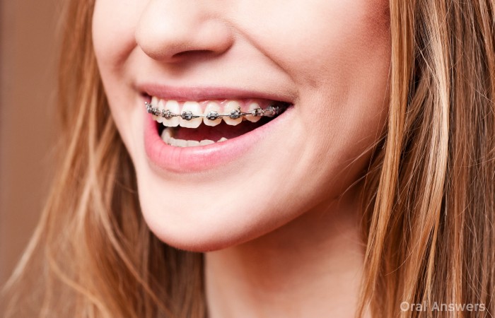 Braces and Pain