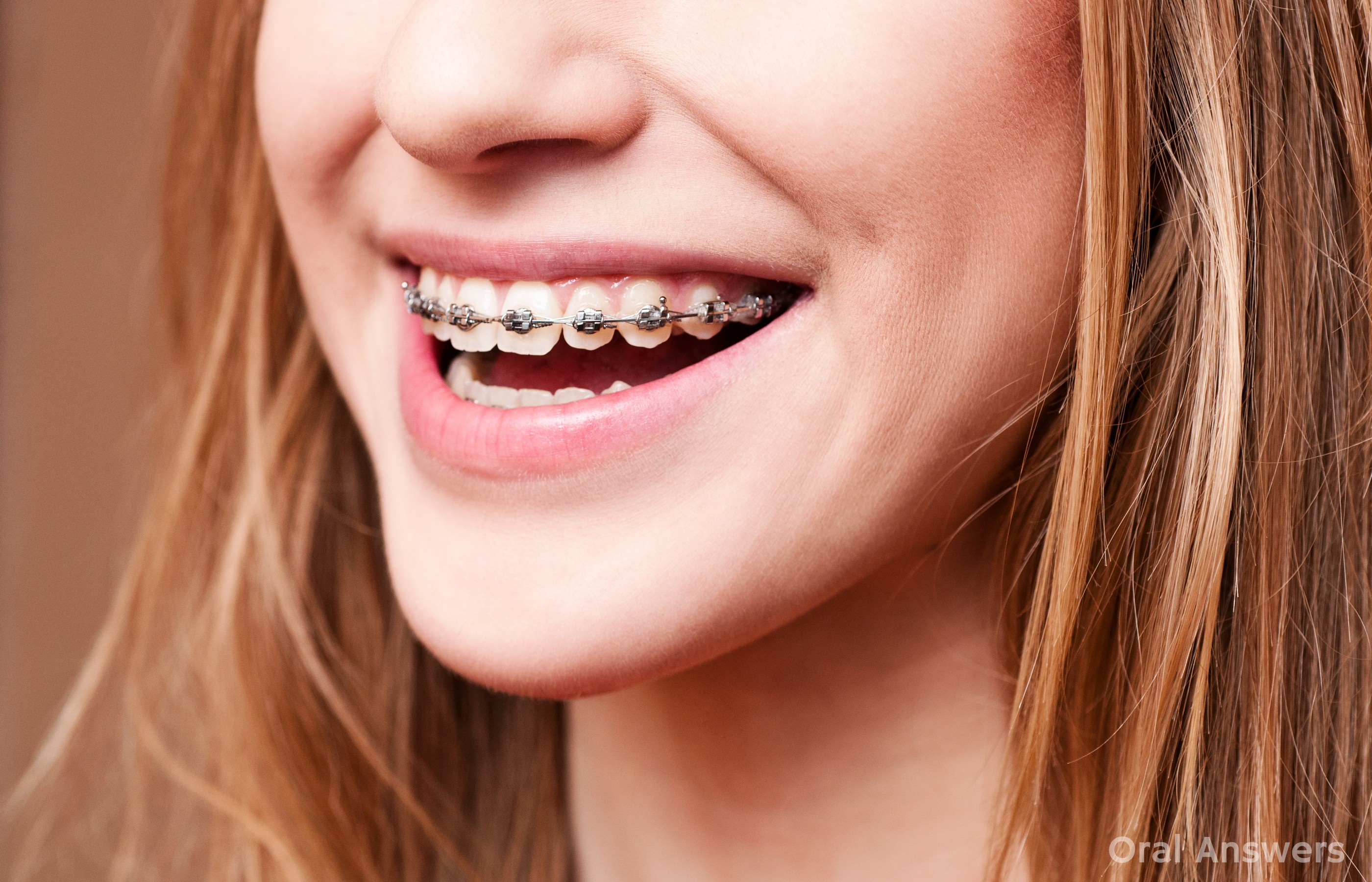 Do Braces Hurt? | Oral Answers