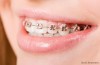 Why Braces Have Two Colored Bands Around Them