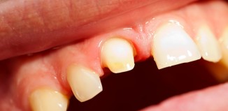 Best Temporary Crown Cement and Way to Recement Crowns