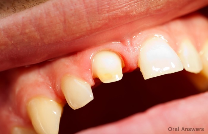 Best Temporary Crown Cement and Way to Recement Crowns