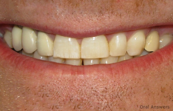Dental Fluorosis Stains Teeth Chalky White