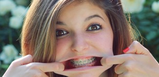 Is a Labial Frenectomy Necessary After Braces?