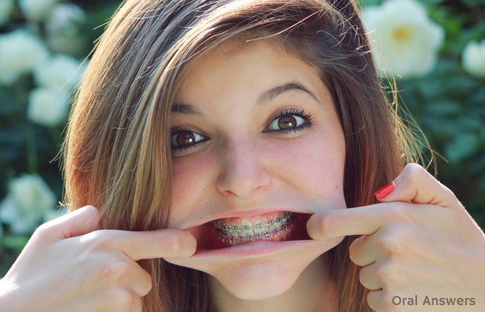 Is a Labial Frenectomy Necessary After Braces?