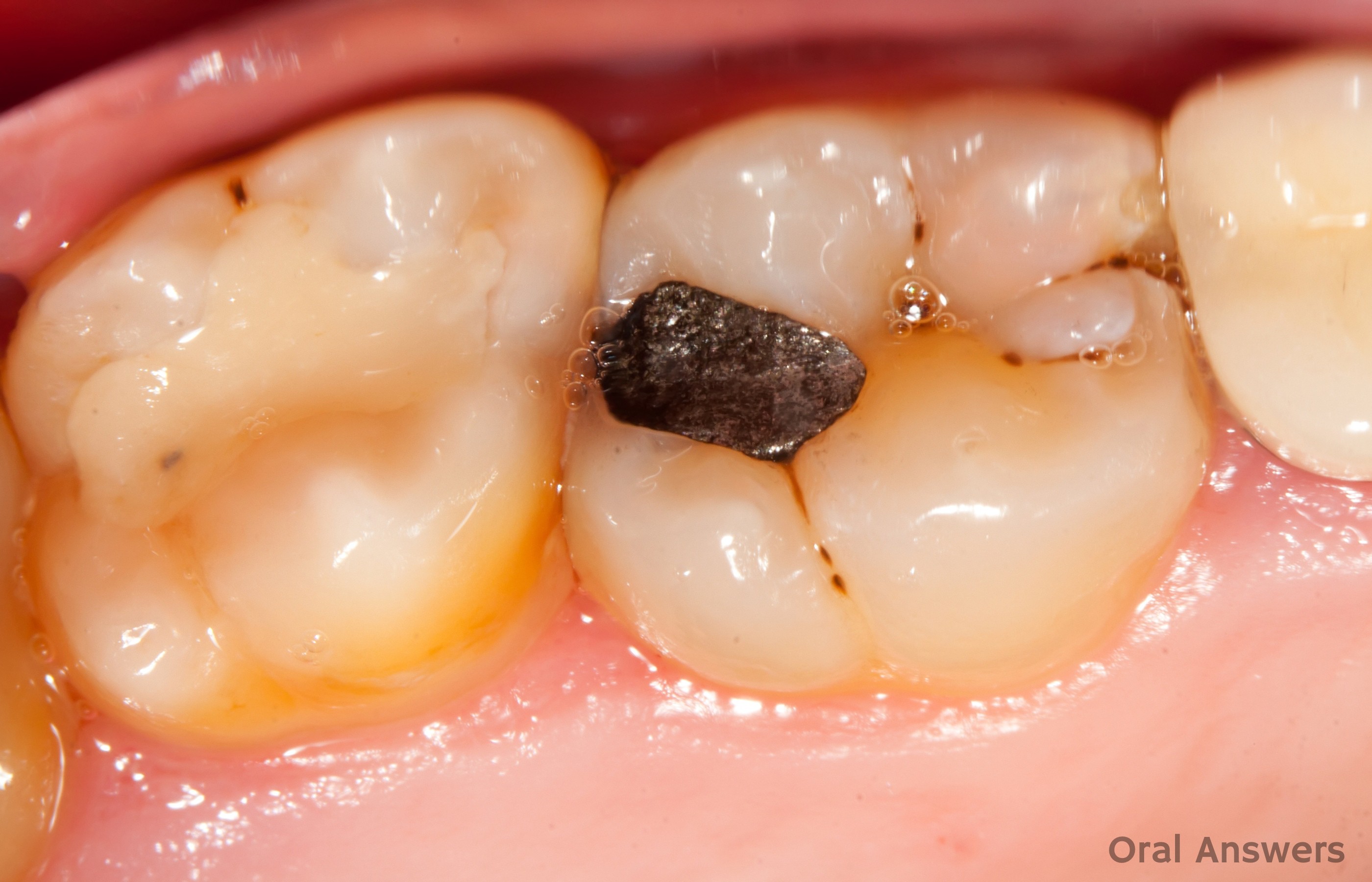 What do White and Silver Fillings Look Like?