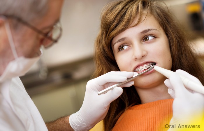 Can General Dentists Do Braces?