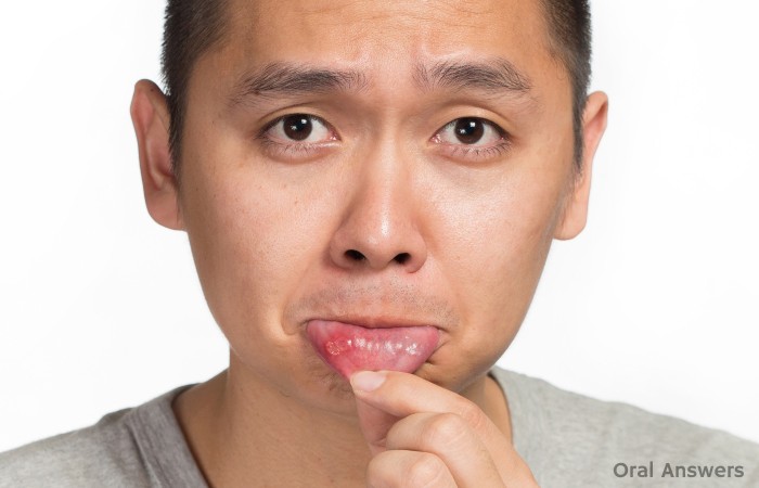 Cause of Canker Sores