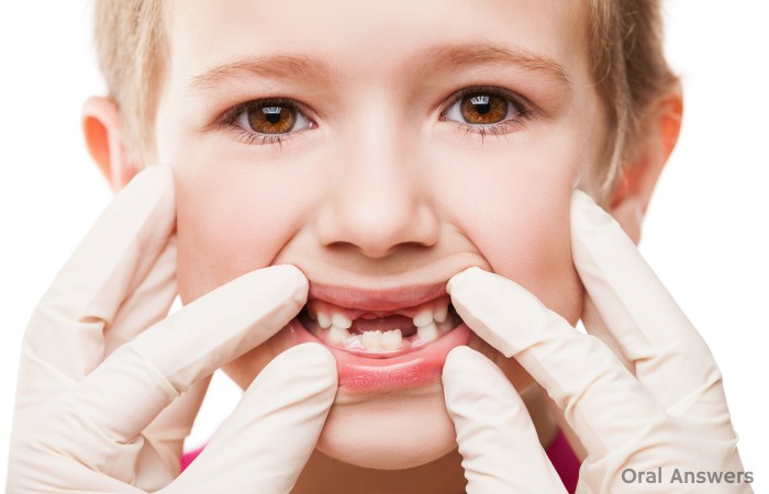 Cavities In Baby Teeth: Do They Need Fillings?
