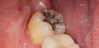 Contents of Silver Amalgam Fillings