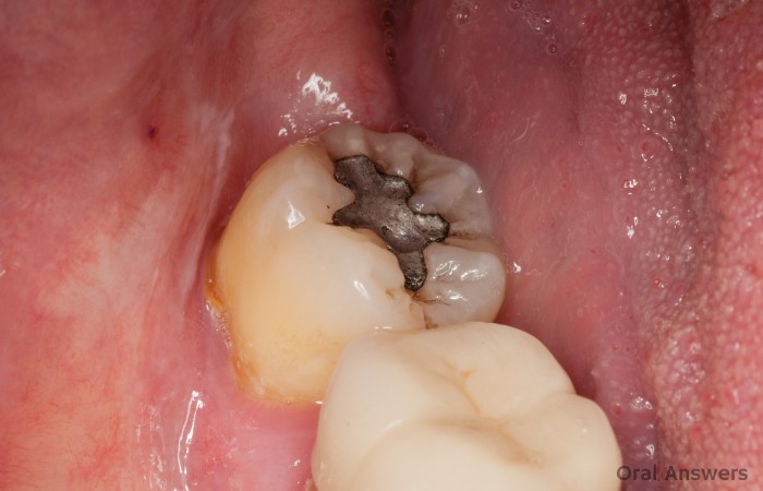 Contents of Silver Amalgam Fillings