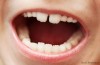 Mamelons on Teeth Wear Down