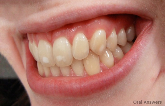 Dental Fluorosis