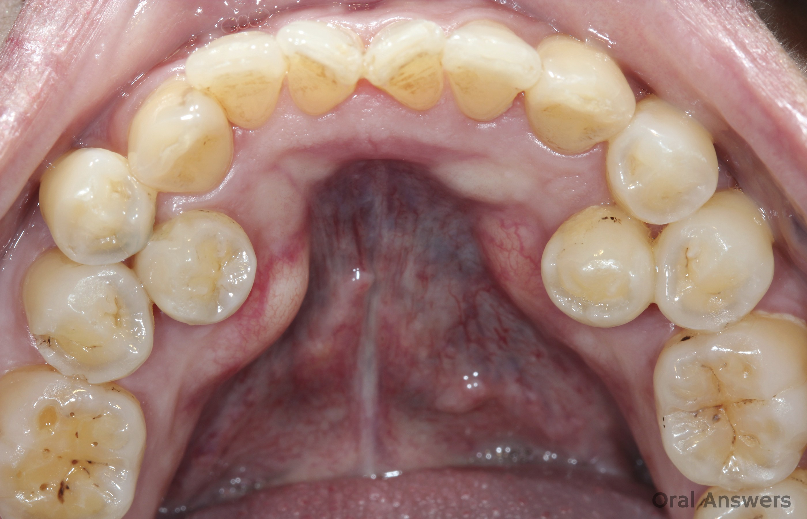 What are the main steps of a front tooth extraction procedure?