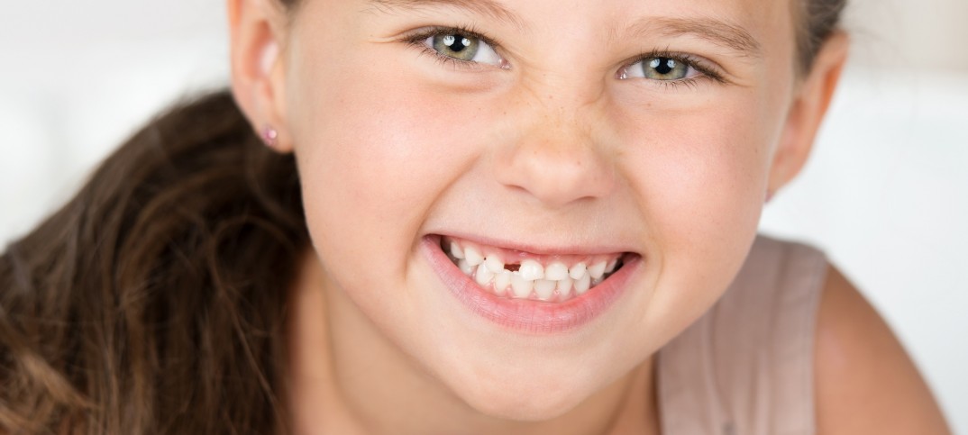Congenitally Missing Teeth