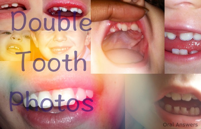 Double Tooth Photos