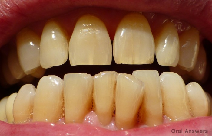 Craze Lines: Hairline Cracks In Your Front Teeth | Oral ...