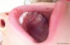 Eruption Cyst Baby Molar