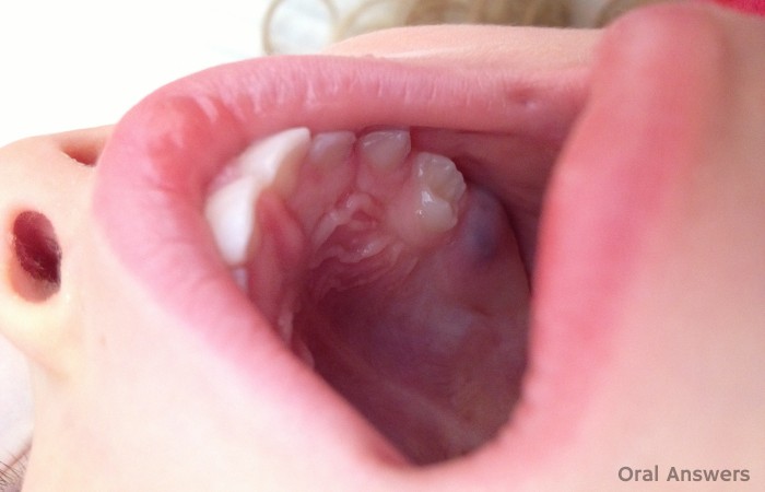 Eruption Cyst Baby Molar