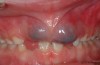 Dental Eruption Cyst Upper Front Teeth