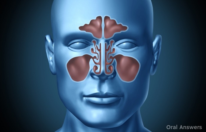 Sinus Infection Can Cause Tooth Pain