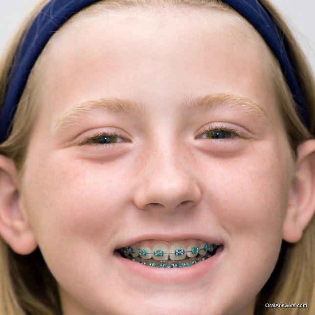 60 Photos of Teenagers with Braces – Oral Answers