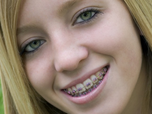 Topless Braces