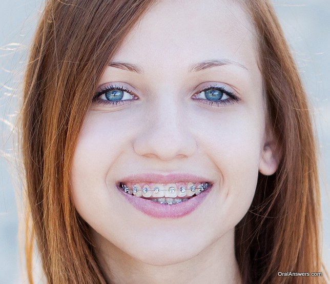 Brown teen big ass with braces 60 Photos Of Teenagers With Braces Oral Answers