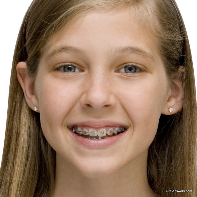 60 Photos of Teenagers with Braces - Robweigner's blog