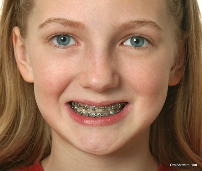 Cute Girl Braces For Teeth – Telegraph