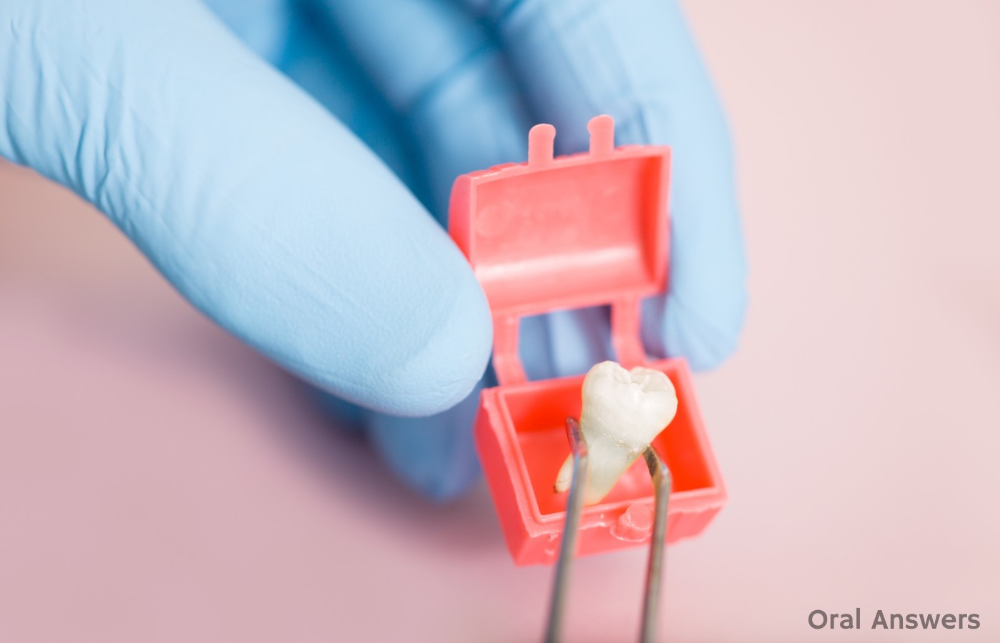 Can You Keep Your Extracted Teeth? Oral Answers