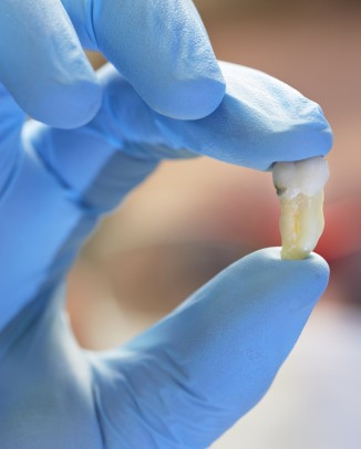 What Happens to Extracted Teeth?